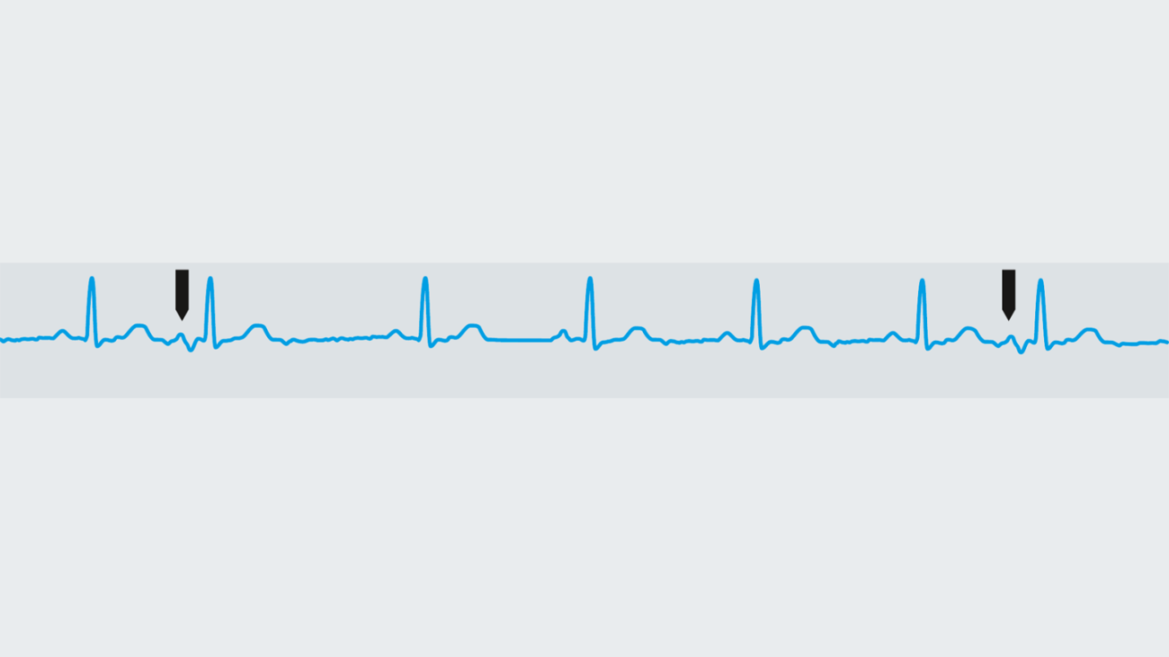 Nonperiodic disturbances in a periodic ECG signal Nonperiodic disturbances in a periodic ECG signal
