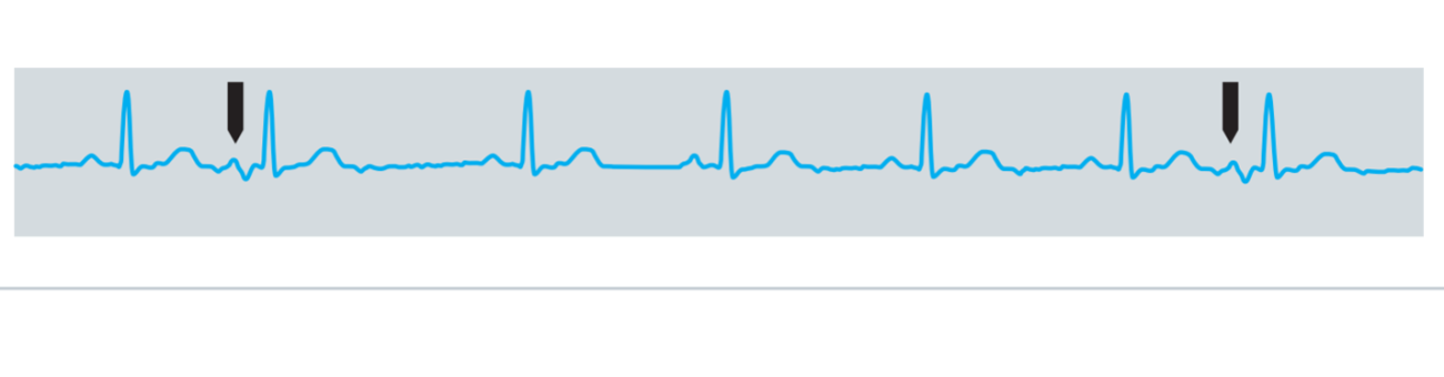Nonperiodic disturbances in a periodic ECG signal Nonperiodic disturbances in a periodic ECG signal